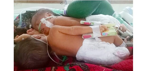 Bayi Kembar Siam asal Babat Lamongan Dirujuk ke RSUD Dr Soetomo Bayi Kembar Siam asal Babat Lamongan Dirujuk ke RSUD Dr Soetomo