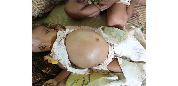 Dinsos Kabupaten Madiun Jamin Biaya Pengobatan Bayi Penderita Hisprung Secara Gratis Dinsos Kabupaten Madiun Jamin Biaya Pengobatan Bayi Penderita Hisprung Secara Gratis