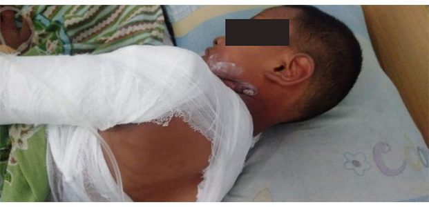 Nyalakan Mercon, Bocah 9 Tahun asal Sumobito Jombang Alami Luka Bakar Serius Nyalakan Mercon, Bocah 9 Tahun asal Sumobito Jombang Alami Luka Bakar Serius