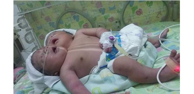 Setelah 10 Hari Dirawat di RS, Bayi Berkepala Dua di Gresik Akhirnya Meninggal Dunia Setelah 10 Hari Dirawat di RS, Bayi Berkepala Dua di Gresik Akhirnya Meninggal Dunia