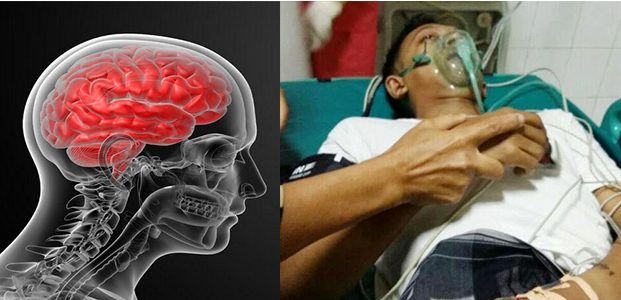 Tanda dan Gejala Matinya Batang Otak Pada Manusia Tanda dan Gejala Matinya Batang Otak Pada Manusia